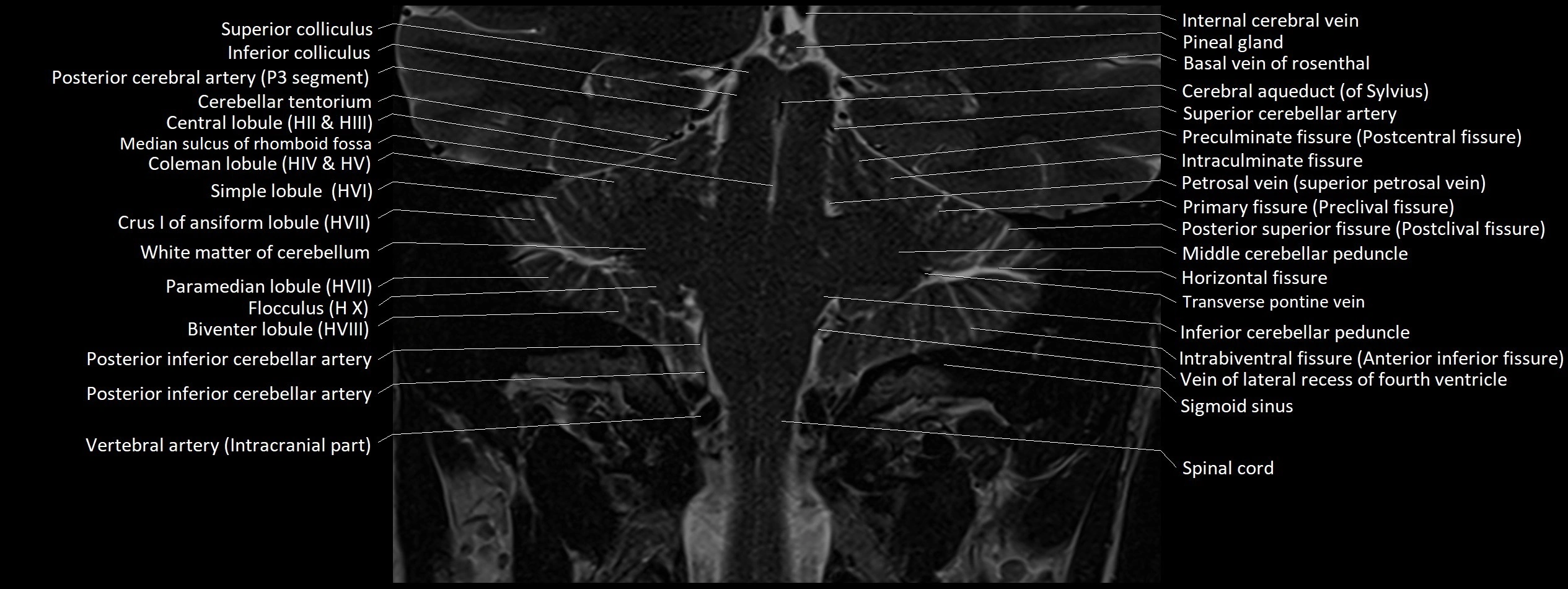 Anatomy of cerebellum coronal cross sectional 3T image 6.webp